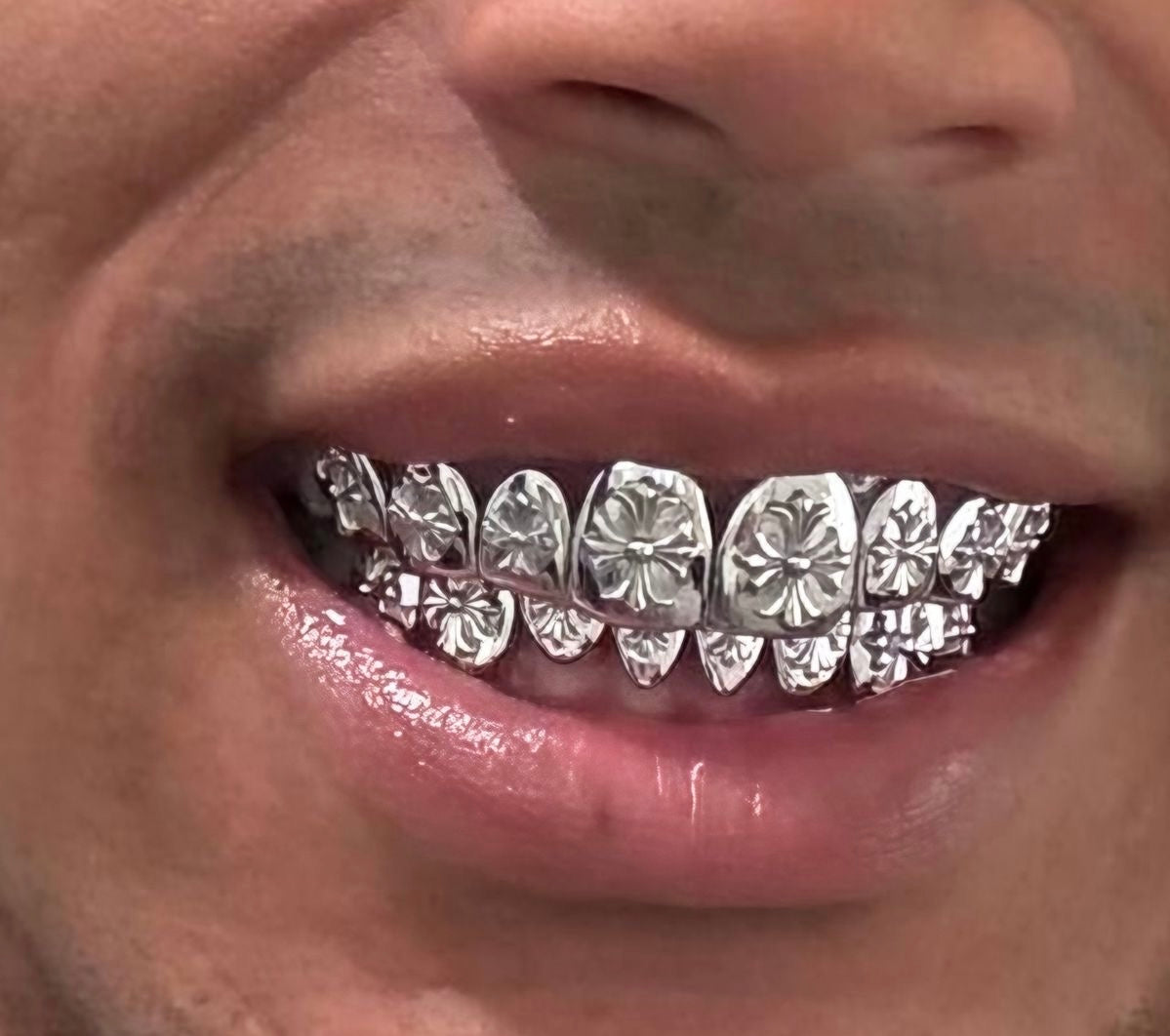 Grillz sur mesure à distance | Diamond Rock - Grillz personnalisés en France